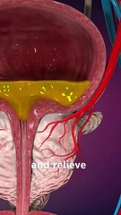 Prostate Artery Embolization (PAE)
