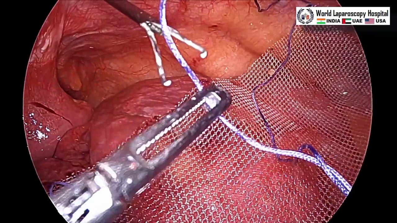 Mastering Laparoscopic Technique: Recurrent Incisional Hernia Repair by Laparoscopy Simplified