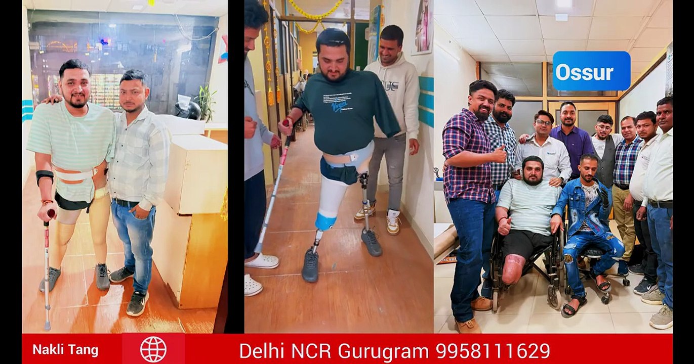 Above knee Amputation Op4 knee joint nakali hath ossuer liner