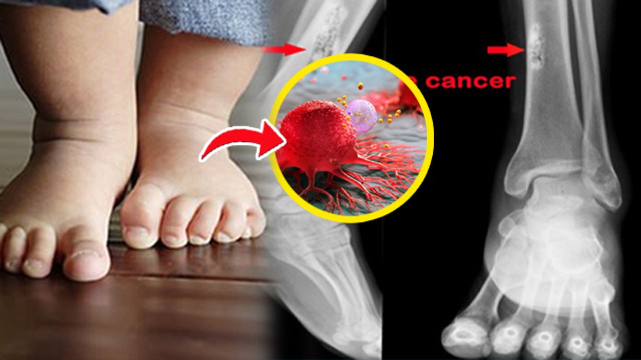Bone Cancer Symptoms In Children:बच्चों में बोन कैंसर क्यों होता है, लक्षण और बचाव | Boldsky