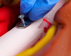 How Doctors Handle Serious Bone Breaks