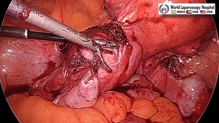 Total Laparoscopic Hysterectomy for a Patient with Broad Ligament Fibroid