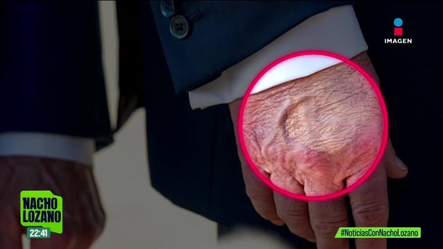 Donald Trump padece insuficiencia venosa, informó la Casa Blanca