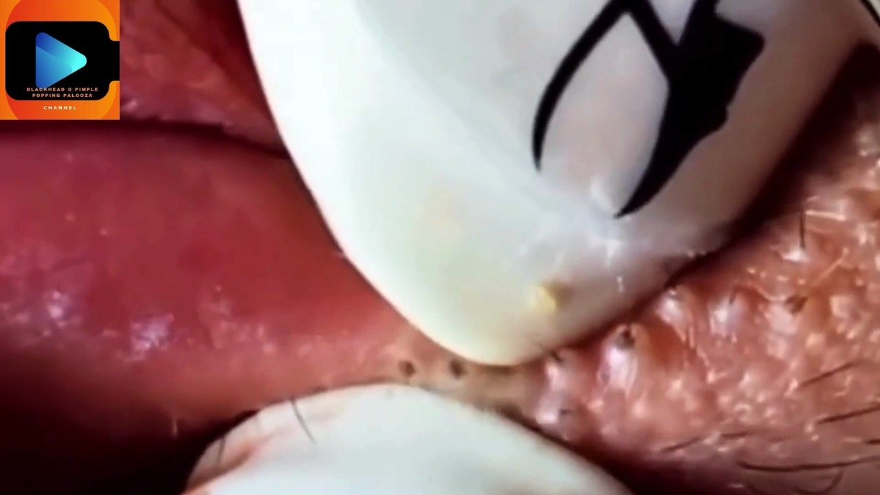 Blackhead Poppin’ Party: When Your Nose Turns Into a Rice Dispenser