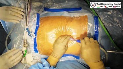 Total Laparoscopic Hysterectomy with Right Inguinal and Left Incisional hernia repair by three-port