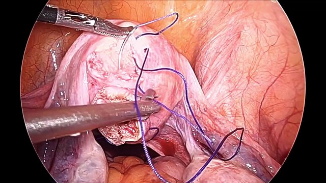 Laparoscopic Myomectomy for Pedunculated Myoma A minimally invasive procedure with maximum benefits