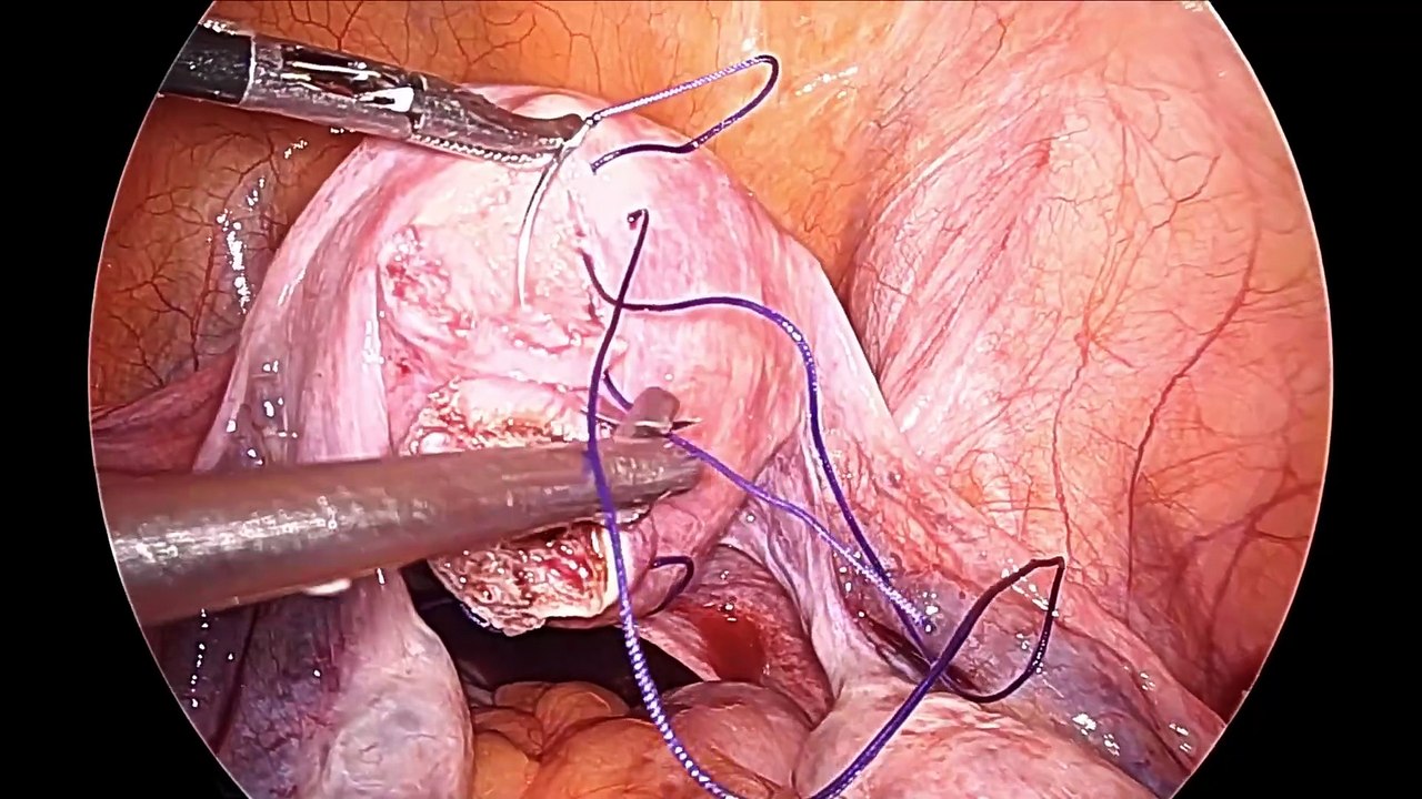 Laparoscopic Myomectomy for Pedunculated Myoma A minimally invasive procedure with maximum benefits