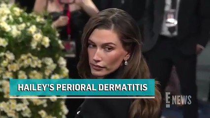 Hailey Bieber Shares Look at Her Perioral Dermatitis Flare Up