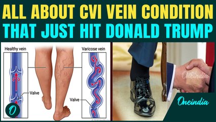 What Is Chronic Venous Insufficiency? Trump Diagnosed With Medical Issue After Leg Swelling Images