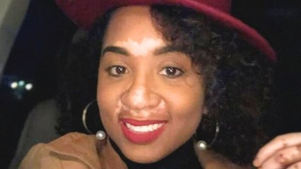 Woman Talks About Her Vitilogo and Promoting Self-Acceptance.