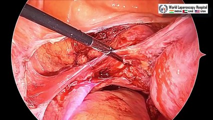 Total Laparoscopic Hysterectomy for Large Lateral Wall Fibroid Uterus