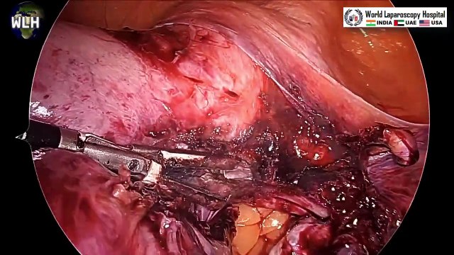 Innovative Laparoscopic Hysterectomy_ Integrating ICG & U-Kit and Safe Contained Morcellation