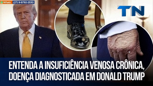 Entenda a insuficiência venosa crônica, doença diagnosticada em Donald Trump