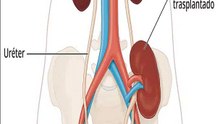 Así se realiza un trasplante de riñón