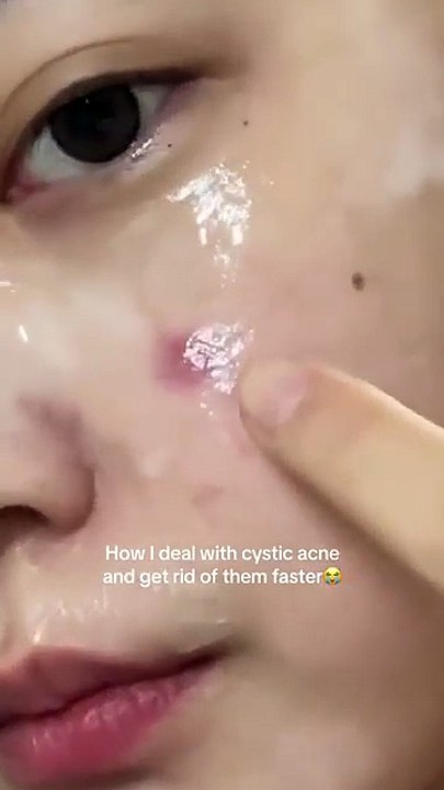 The best way to deal with acne in the same place on the face