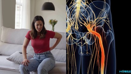 Lumbar Radiculopathy vs Sciatica: Key Differences You Need to Know 🩺