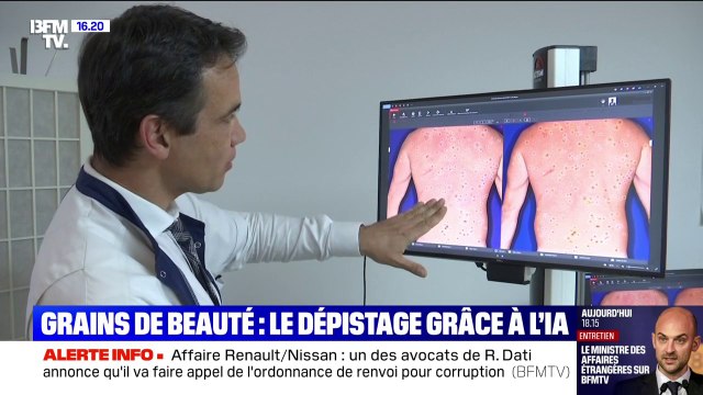 Santé: le dépistage des grains de beauté est possible grâce à l'IA