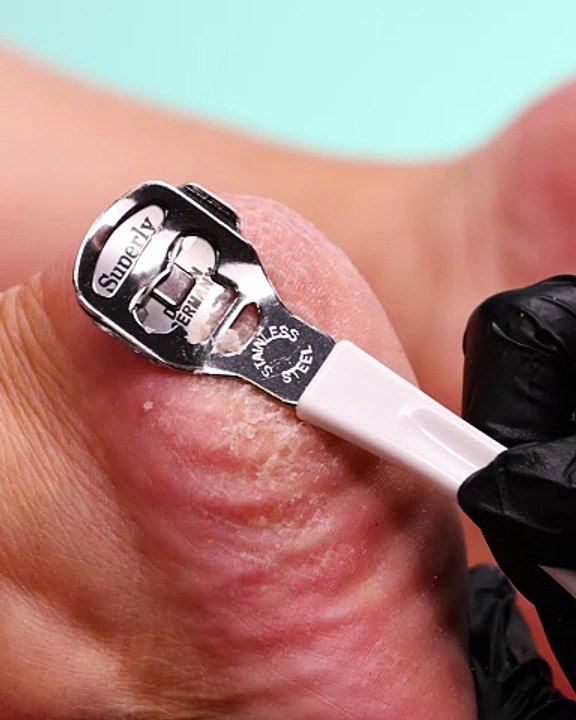 From cracked heels to smooth heels! 👣✨