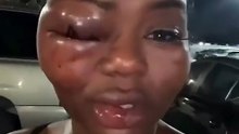 This woman got into a serious fight, leaving half of her face swollen and her eye swollen shut