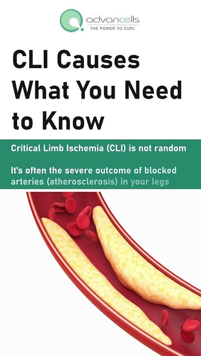 Are You at Risk for Critical Limb Ischemia?