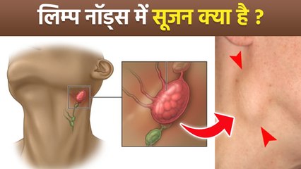 Lymph Node Swelling: लिम्फ नोड्स में सूजन का कारण,लक्षण,जांच | Symptoms & Home Remedy