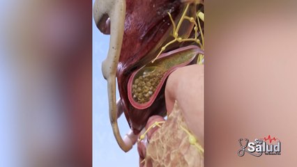 Su Salud: Piedras en la vesícula