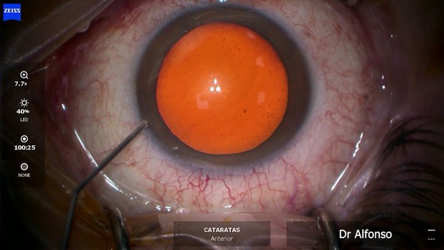 SALUD | Así se realiza una operación de cataratas