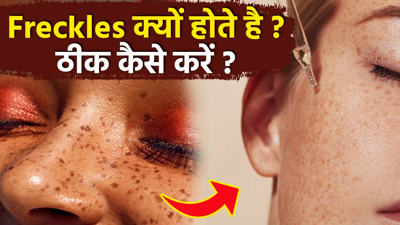 Freckles Treatment At Home: Freckles Kyu Hota Hai,Removal Cream & Home Remedies|Boldsky