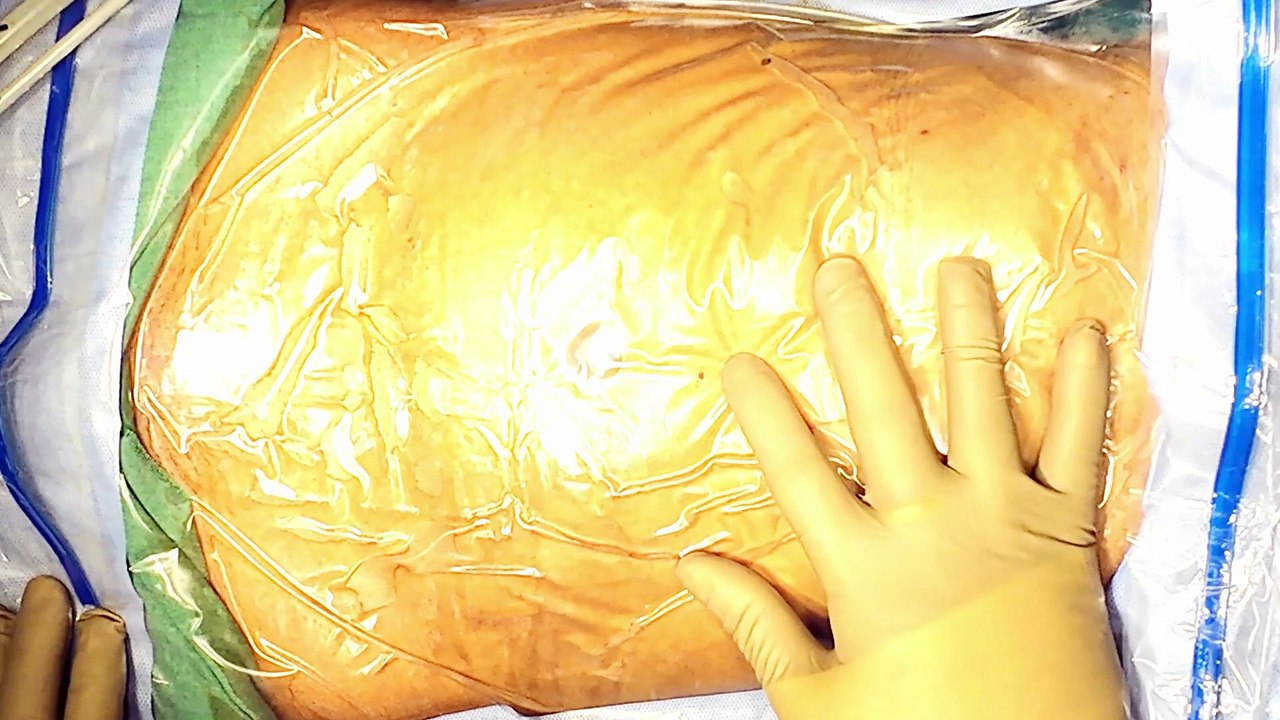 Minimally Invasive Approach Laparoscopic Ovarian Cystectomy Explained by Dr RK Mishra