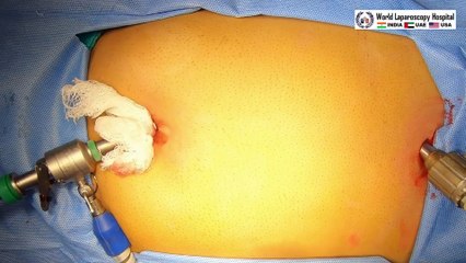 Laparoscopic Cholecystectomy Fully Explained SkintoSkin Video with Near Infrared Cholangiography