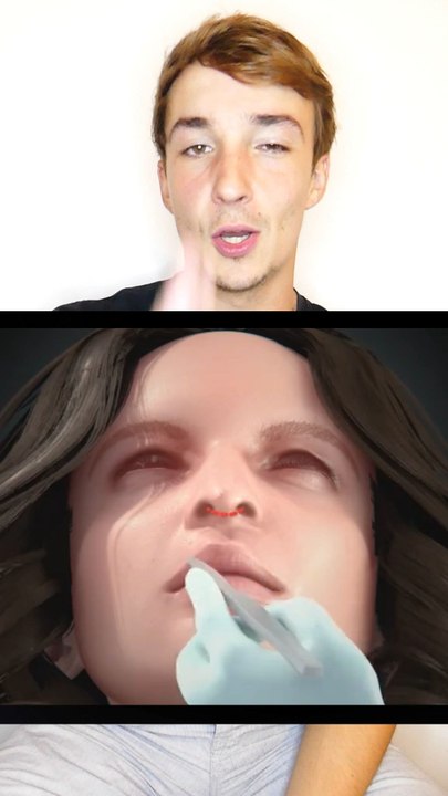 Rhinoplastie