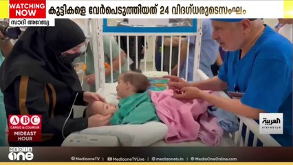 സൗദിയിൽ സിറിയൻ സയാമീസ് ഇരട്ടകളുടെ ശസ്ത്രക്രിയ വിജയകരമായി പൂർത്തിയാക്കി