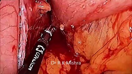 Mini Gastric Bypass Step by Step Demonstration by Dr R K Mishra