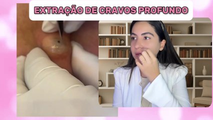 EXTRAÇÃO DE CRAVOS PROFUNDOS NA PELE | LIMPEZA DE PELE COMENTADA POR ESTETICISTA