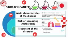 Stomach cancer: treatment and risk of metastasis