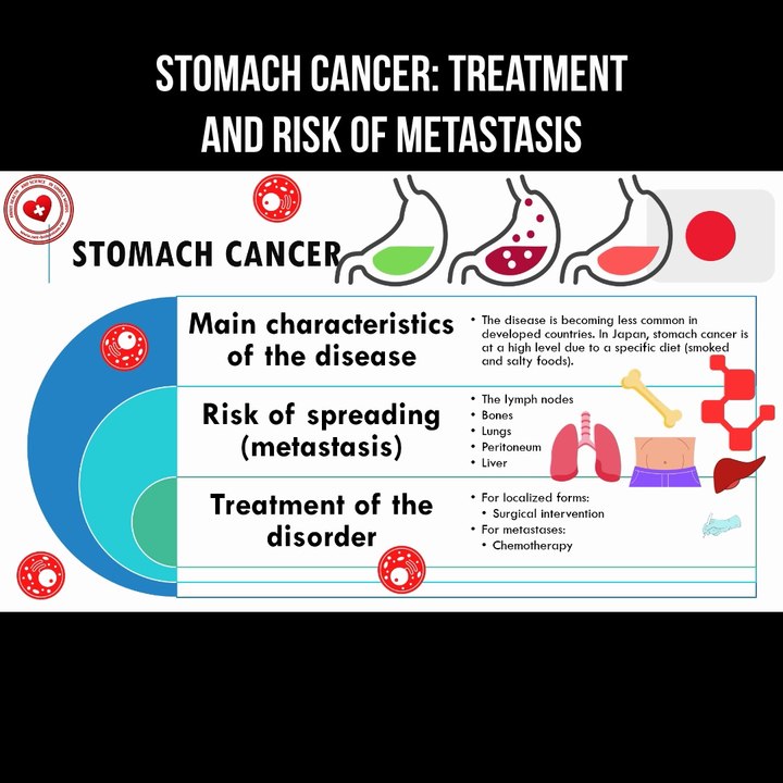 Stomach cancer: treatment and risk of metastasis