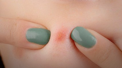 Tamannaah Bhatia के पिंपल्स हैक पर डॉक्टर की राय