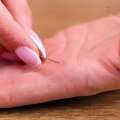 Stuck splinter gets removed easily