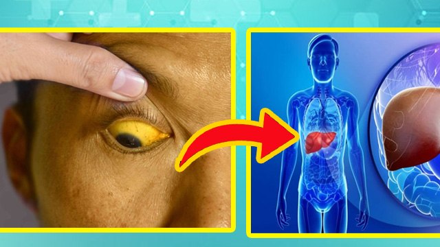 पीलिया कब होता है जानलेवा खतरनाक,Piliya Kab Khatarnak Hota Hai|Jaundice Symptoms | Boldsky
