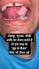 मुंह के कैंसर की जांच ।