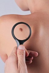 Melanoma, diagnosi e cure