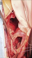 Rotura cardíaca: causas, síntomas y tratamiento urgente