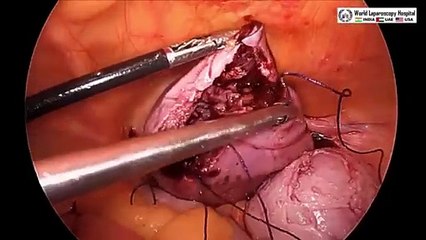Laparoscopic Myomectomy with Tubal Ligation by Falope Ring
