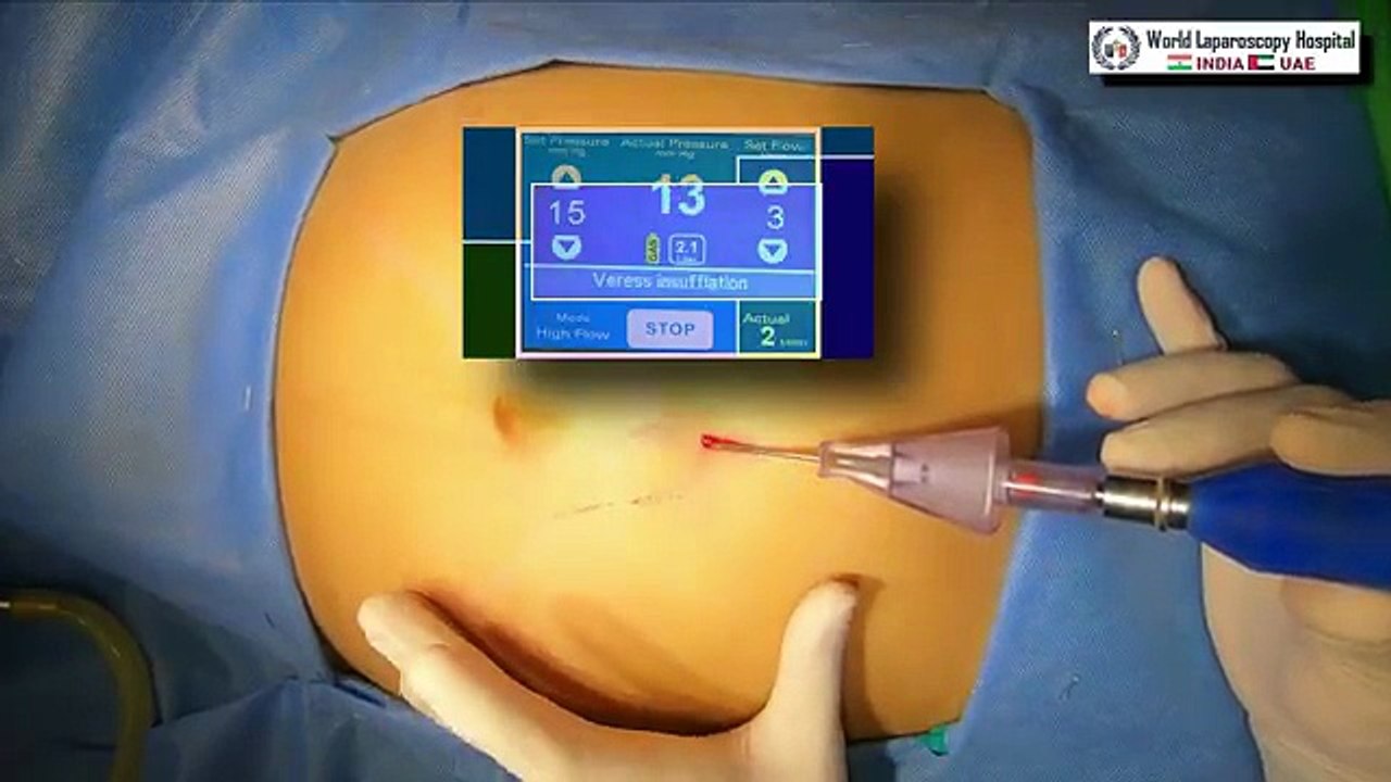 How to perform safe Dermoid Ovarian Cystectomy without Spillage