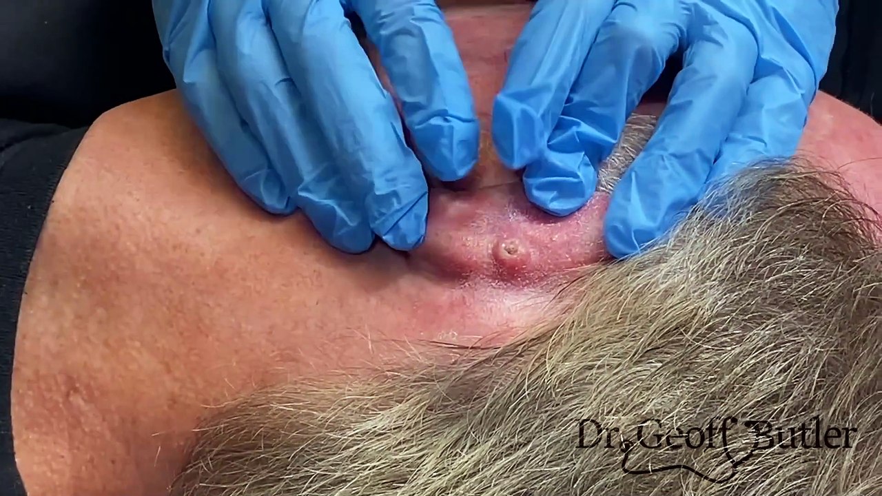 Removal of a Squamous Cell Cancer from behind the Ear