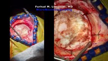 Brain tumor and awake brain surgery Resection of metastatic melanoma