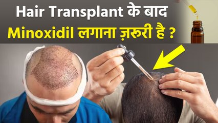 Hair Transplant के बाद Minoxidil Use करना Safe है या नहीं| Is Minoxidil Safe to Use After Transplant