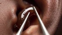 Earwax brown beans removal #earwax