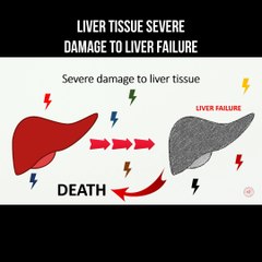 Liver tissue severe damage to liver failure