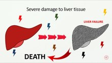 Liver tissue severe damage to liver failure